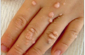 Verrue et molluscum contagiosum