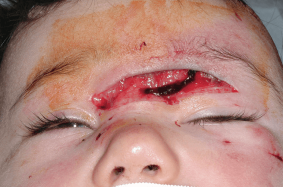 Morsures de chien Morsures de chien