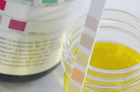 Purpura rhumatoïde : quel suivi en ville et en néphrologie ? Purpura rhumatoïde : quel suivi en ville et en néphrologie ?