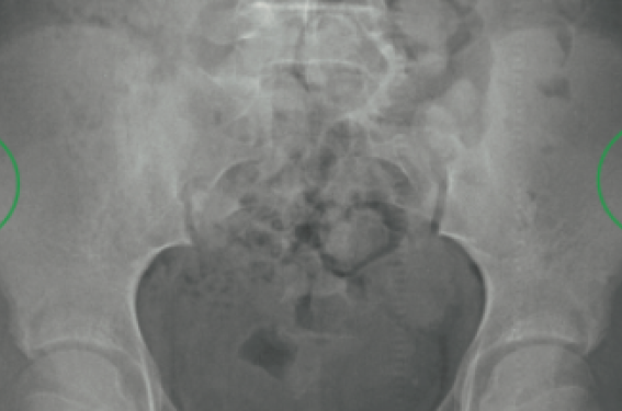 Sever, Osgood Schlatter, des maladies ?