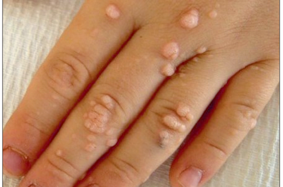 Verrue et molluscum contagiosum Verrue et molluscum contagiosum
