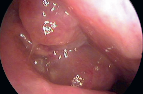 Diagnostic et prise en charge d’une polypose naso-sinusienne chez l’enfant
